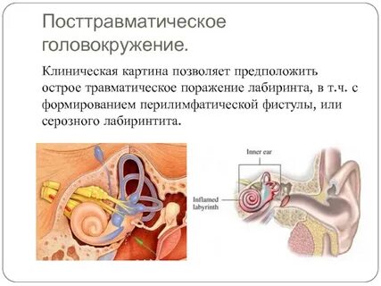 Болезнь меньера по утвержденным клиническим