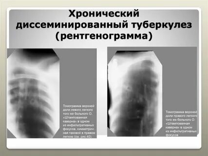Диссеминированный кавернозный туберкулез