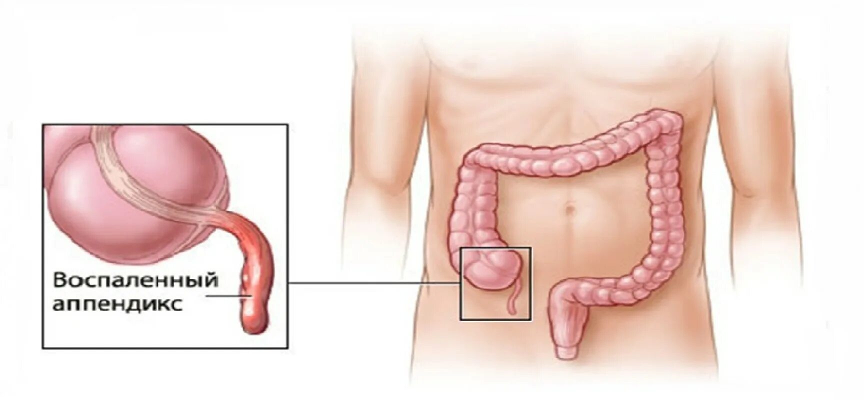 Что болит при аппендиците. Червеобразный отросток аппендикс. Где находится аппендицит. Аппендикс позади слепой кишки. Воспаление аппендикса симптомы.
