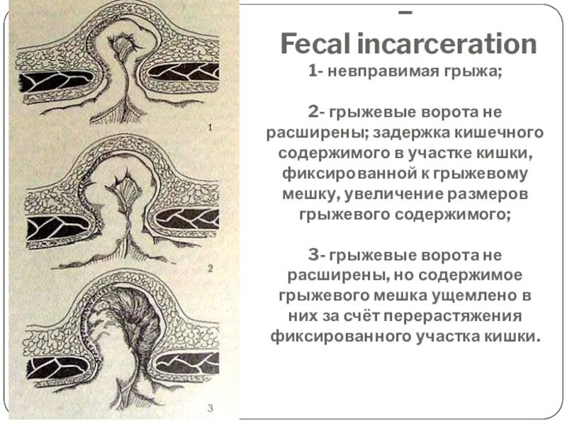 Вызов внешнего ущемления