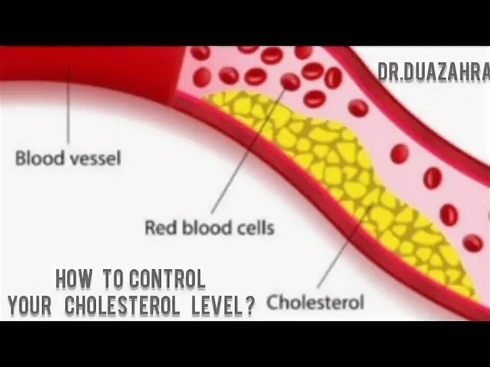Cholesterol levels. Cholesterol levels