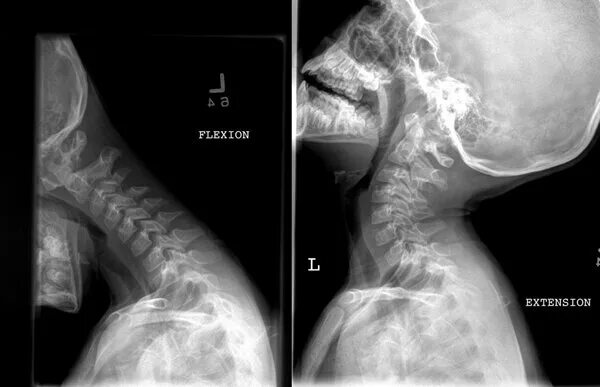Spine x-ray. (Ossiculum terminale). Рентген шейного позвонка. Flexion cervical XRAY. Xray extension