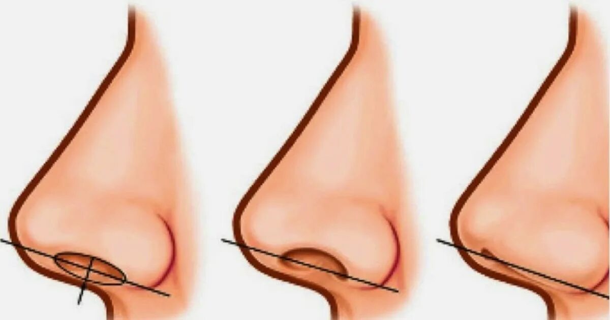 Семечко нос. Колумелла носа операция. келоидный рубец ринопластика. искривление колумеллы носа.
