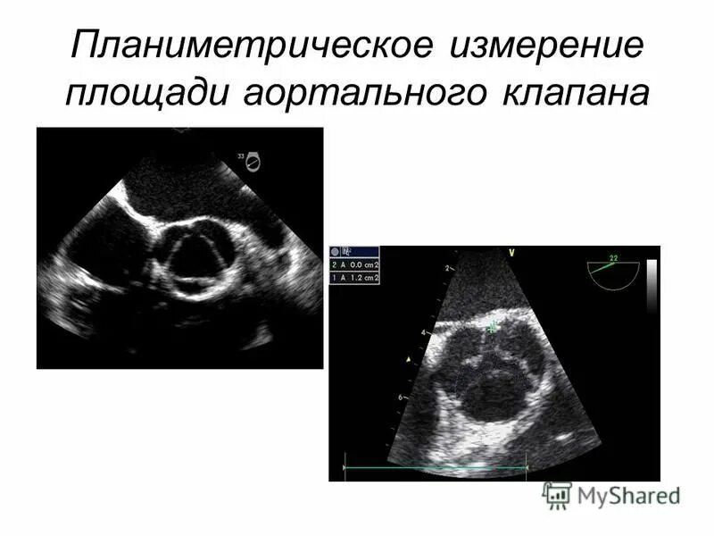 Стеноз аортального клапана степени. Площадь аортального клапана. Площадь аортального клапана. Уравнение непрерывности потока аортальный клапан. Площадь раскрытия аортального клапана норма.