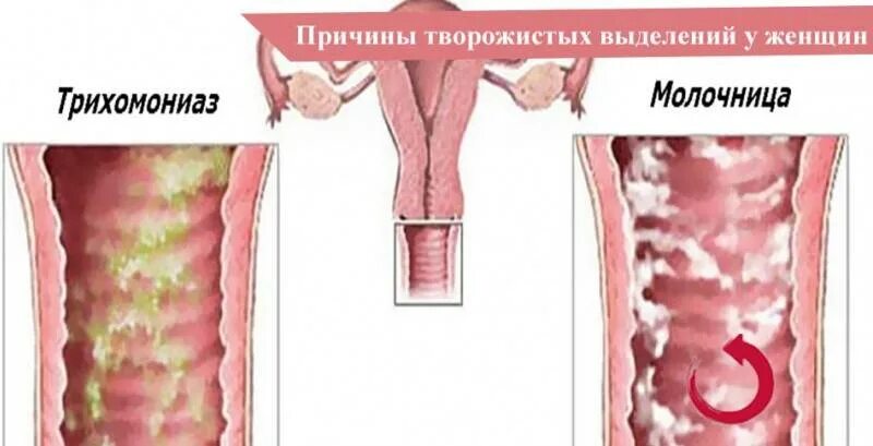 Жжение Во Время Секса