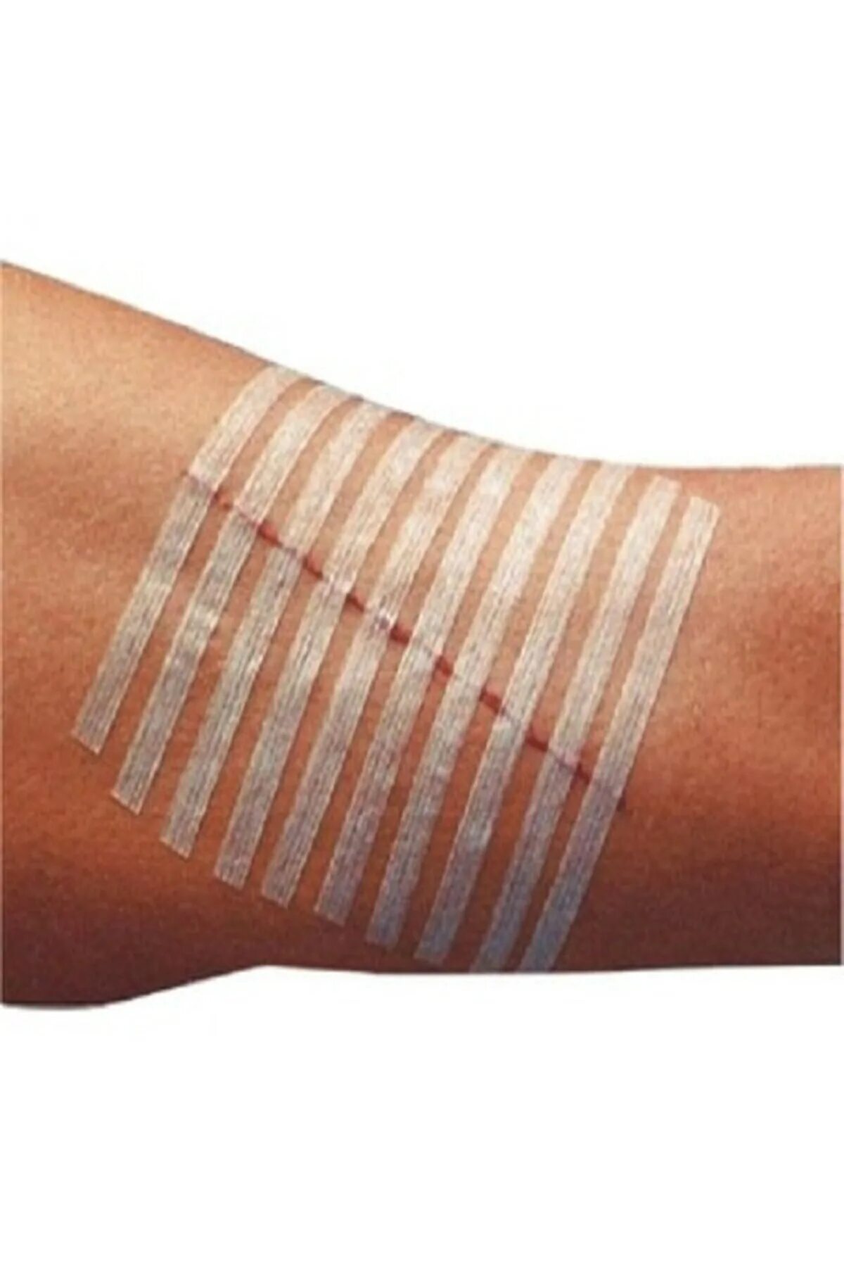 Липкие швы. Стяжки для стягивания краёв резаных ран zipstitch. Липкие швы. Повязка лейкопластырь стерильная для фиксации 20 10 см. Омнистрип пластырь стяжка.