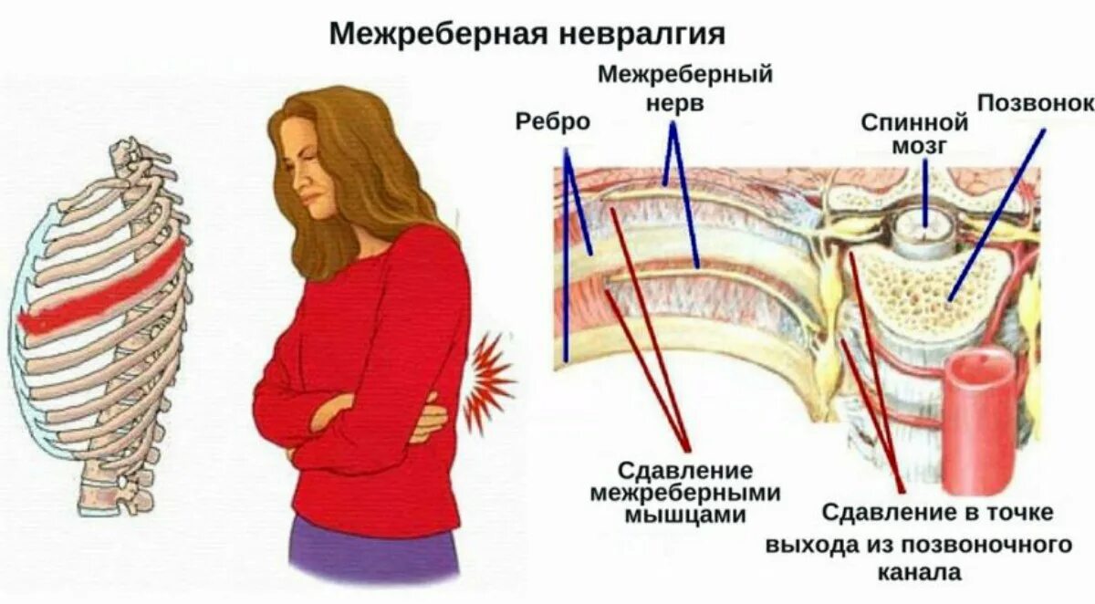 Невралгия при вдохе. Неврология межреберная невралгия симптомы. межреберная невралгия в области сердца симптомы. невралгия межреберного нерва. блокада нерва при межреберной невралгии.