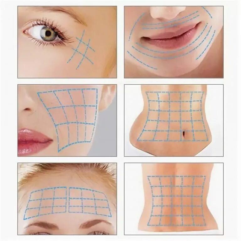 подтяжка нитями до и после. тредлифтинг 3d мезонитями. нити для подтяжки 40. нити аптос для подтяжки подбородка. нити для подтяжки 40.