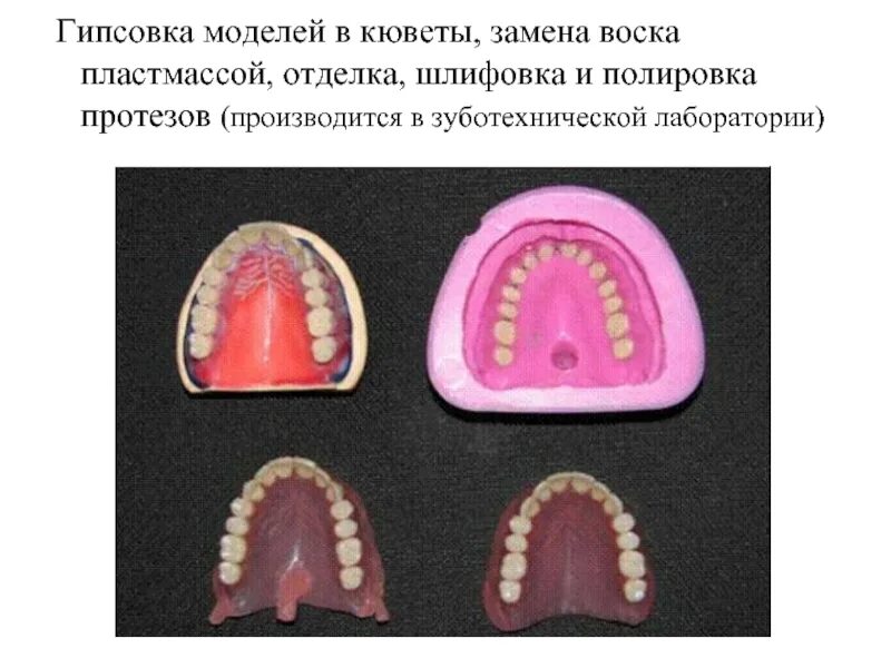 Гипсовка протеза в кювету. Гипсовка восковой композиции протеза в кювету. Гипсовка в кювету частичного съемного протеза. Гипсовка модели в кювету.