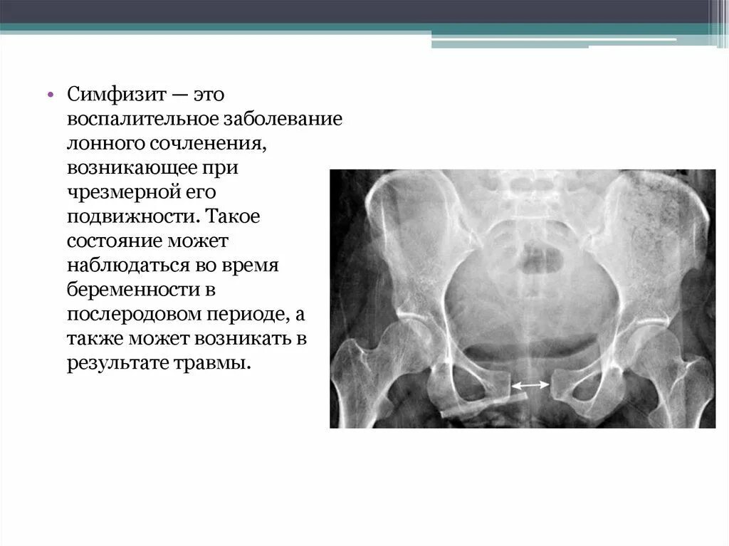 Симфизит при беременности что. Узи лонного сочленения норма. узи лонного сочленения при беременности. расхождение костей лонного сочленения при беременности. симфизит симптомы в 3 триместре.