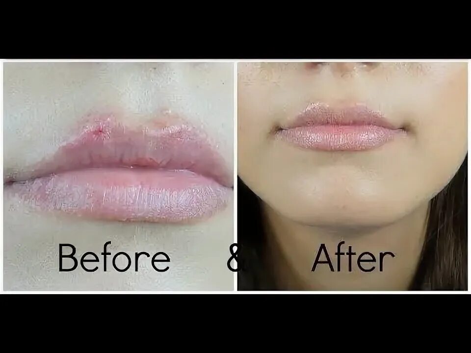 How to get rid of cold sores over night! - YouTube Canker sore, Cold sores remed