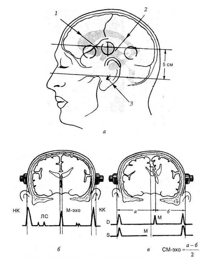 Эхо гостомеля. Эхоэнцефалоскопия при ЧМТ. Эхоэнцефалография (Эхо-ЭГ). Эхоэнцефалоскопия принцип метода. Эхоэнцефалография у детей норма.
