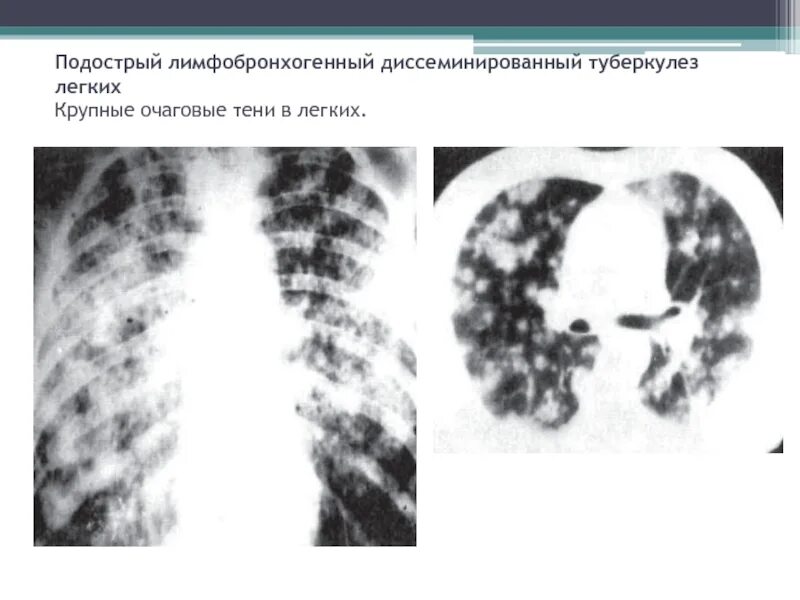 Лимфогенный туберкулез. Диссеминированный туберкулез на кт. Подострый диссеминированный туберкулез рентген. Подострый диссеминированный туберкулез кт. Острый диссеминированный туберкулез рентген.