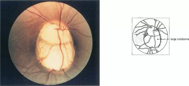 Аномалия развития зрительного нерва. Колобома сетчатки глаза. Колобома зрительного нерва. Колобома хориоидеи глаза.