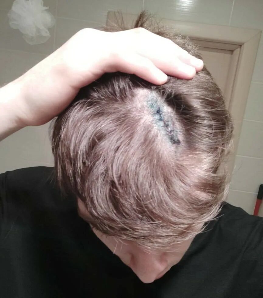 Макушка головы темечко головы. Макушка головы темечко головы. Горит макушка. 2 макушки на голове у мужчины. Схема локализации головной боли.