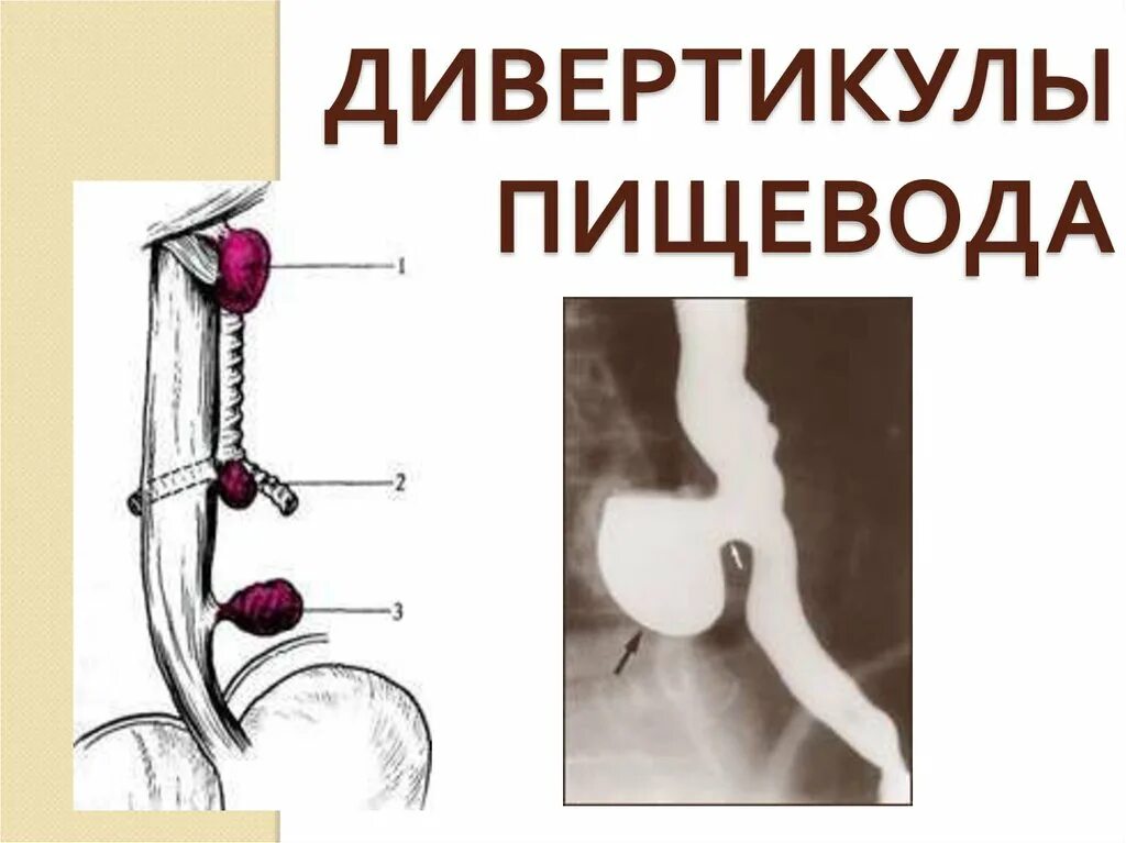 Н пищевода