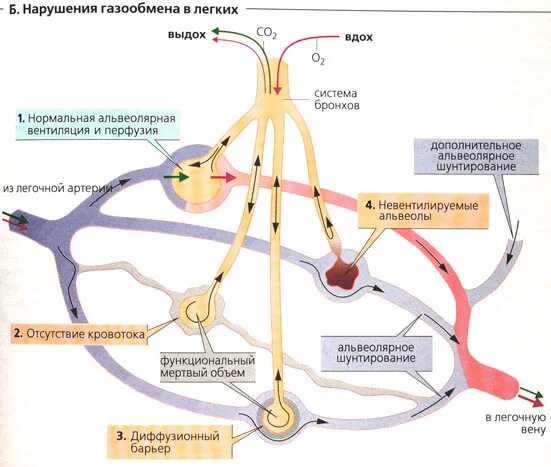 Нарушения газообмена в легких физиология. Легочная и альвеолярная вентиляция физиология. Нарушение газообмена при ХОБЛ. Нарушения газообмена в лёгких. Диффузная способность
