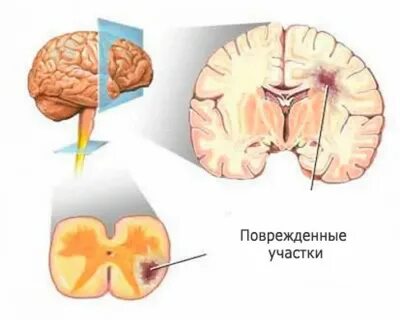 Рассеянный мозг