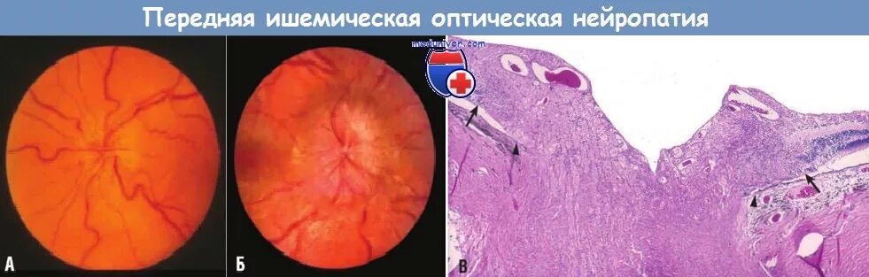 Передняя ишемическая нейропатия зрительного. Нейрооптикопатия зрительного нерва. Ишемическая нейропатия глаза. Ишемическая нейрооптикопатия глаза. Передняя ишемическая нейропатия