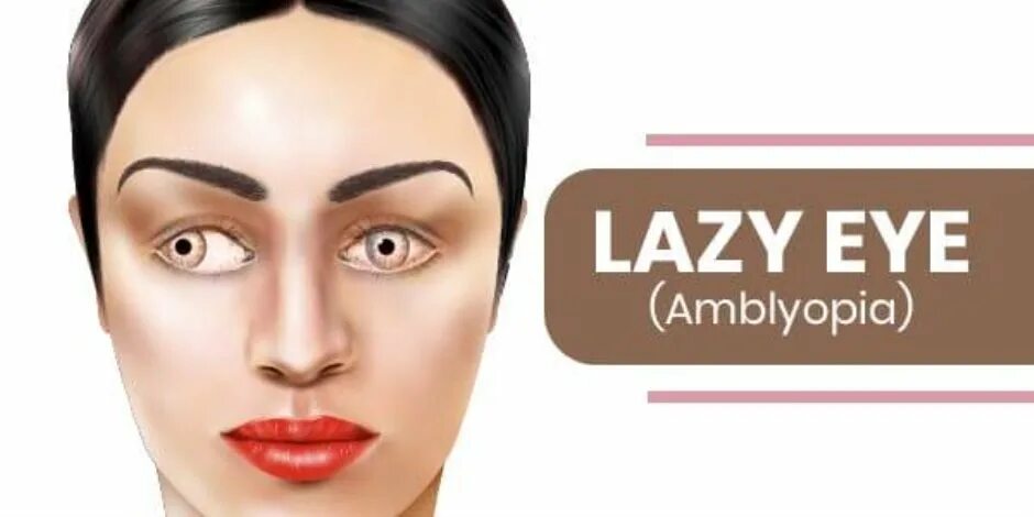 Lazy eye. Lazy eye view.