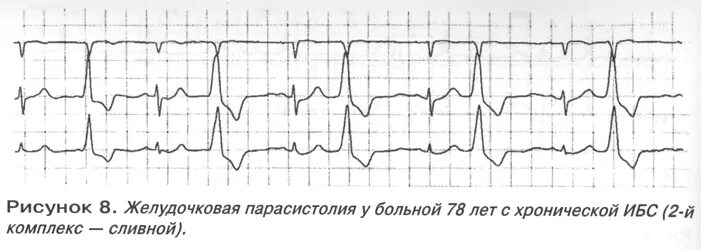 сливные комплексы на экг при экс. критерии парасистолии экг. узкий комплекс qrs на экг. сливные комплексы на экг при парасистолии. сливные комплексы на экг.