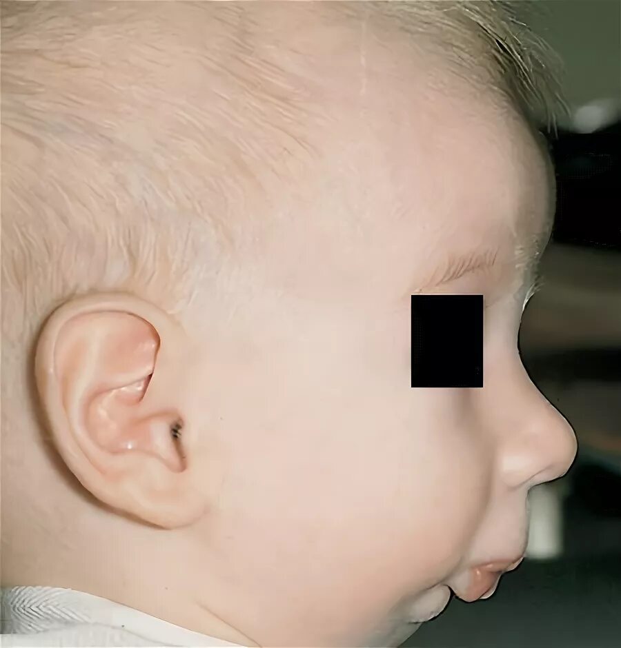 Микрогения. Микрогнатия нижней челюсти. Микрогнатия у новорожденного. Микрогнатия недоразвитие нижней челюсти. Пьера Робена микрогнатия.