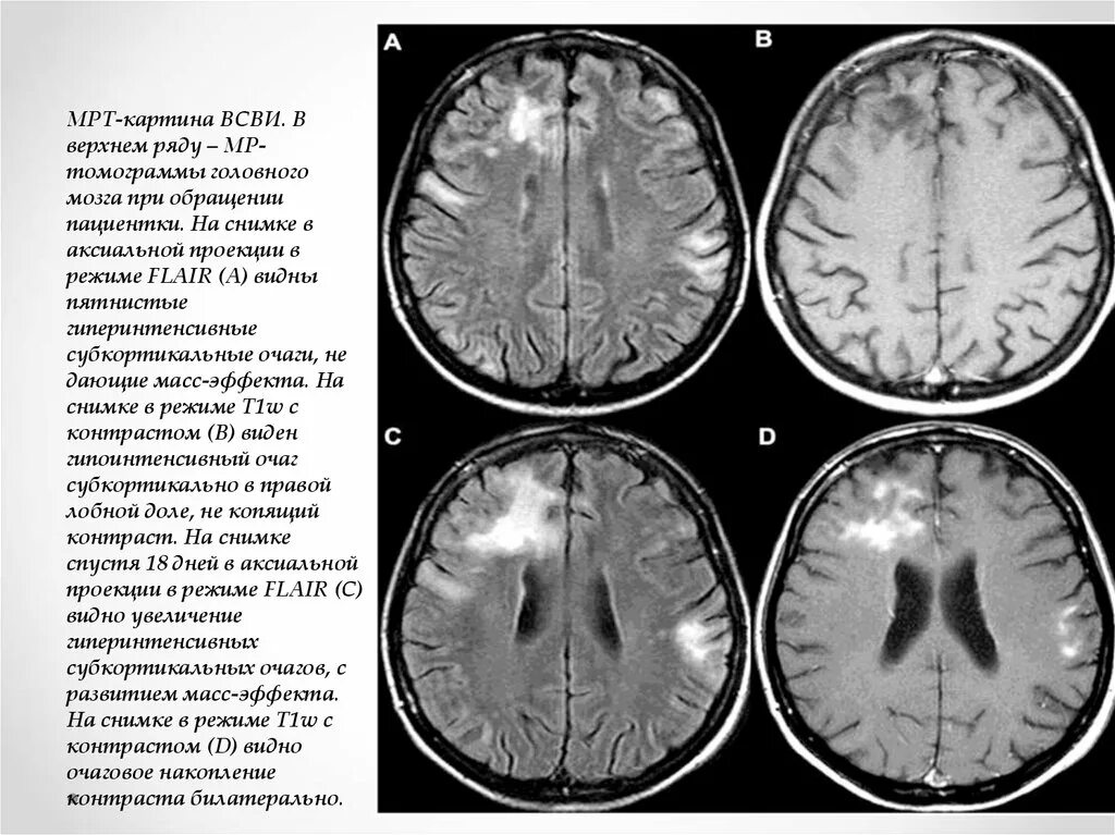 Сосудистый очаг в головном мозге что это. Прогрессирующая лейкоэнцефалопатия мрт. Мультифокальная лейкоэнцефалопатия кт. Мультифокальное поражение головного мозга мрт. Прогрессирующая мультифокальная лейкоэнцефалопатия мрт.