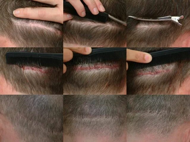 трихопигментация шрамов. трихопигментация головы. трихопигментация рубцов. что такое электроэпиляция волос. татуаж на голове для мужчин.