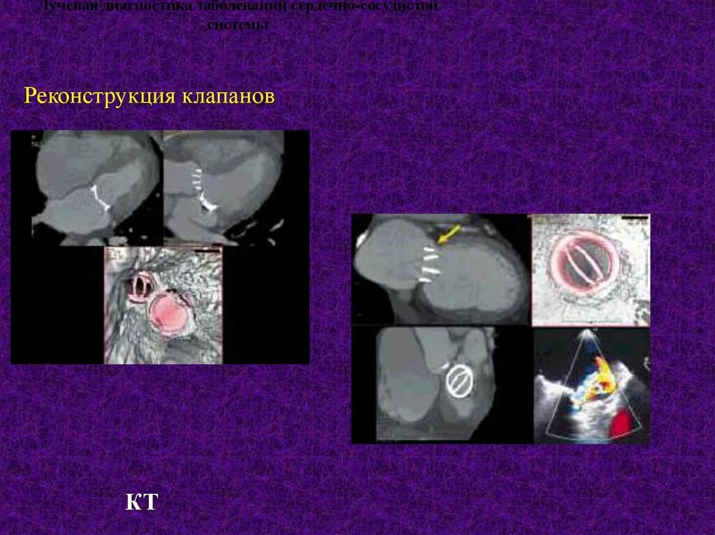 Искусственный клапан кт. Кальциноз митрального клапана на кт.