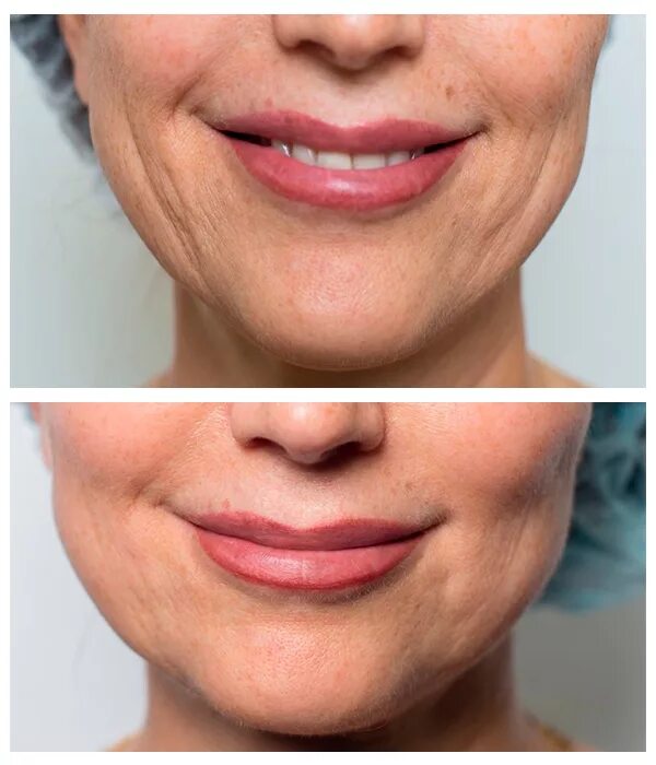 Бланширование белотеро. Бланширование отзывы. Бланширование отзывы. Бланширование морщин белотеро. Бланширование отзывы.