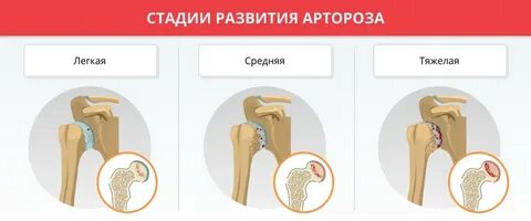 Артроз плечевого сустава мкб 10 коды