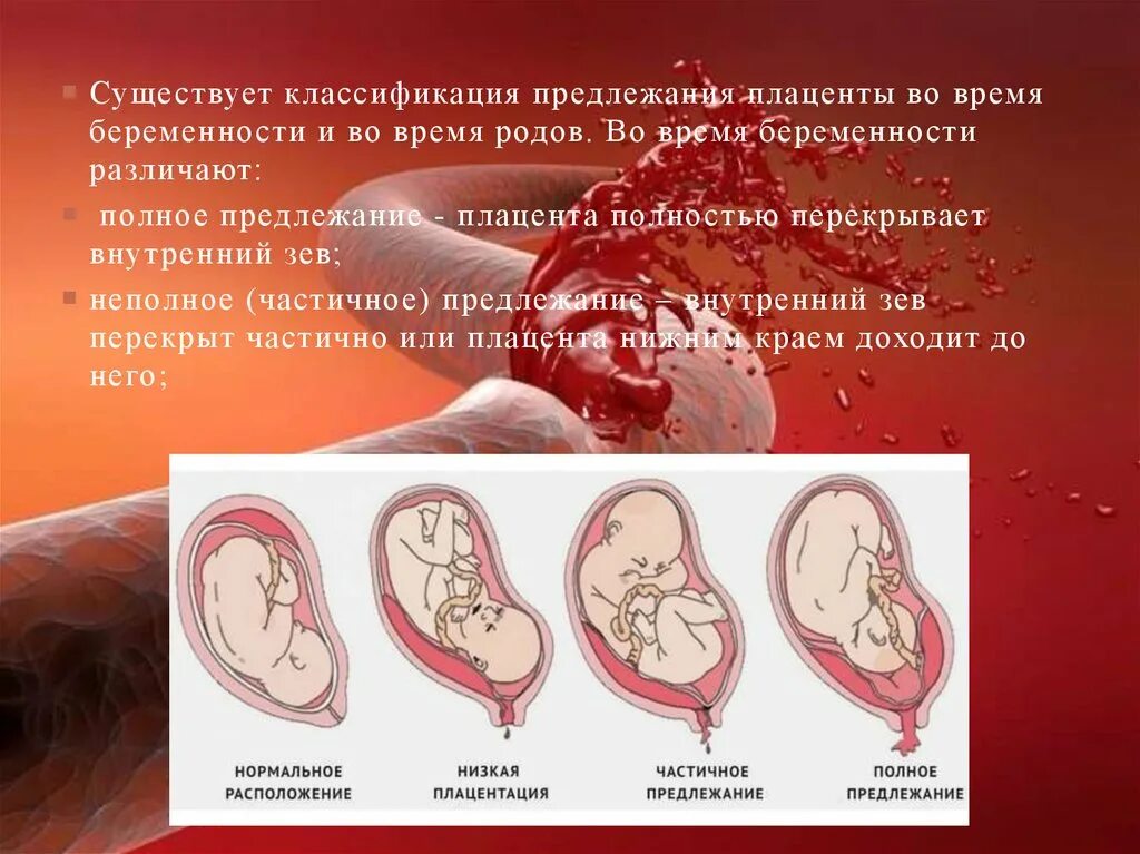 Плацента на какой неделе. Предлежание плаценты. Предлежание плаценты классификация. Полное предлежание плаценты. Частичное предлежание плаценты.