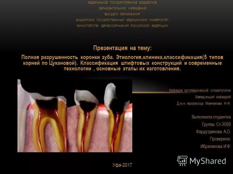 Классификация коронки зуба. Полное разрушение коронки зуба. полное отсутствие коронки зуба классификация. полное отсутствие коронки зуба этиология. этиология полного разрушения коронки зуба.