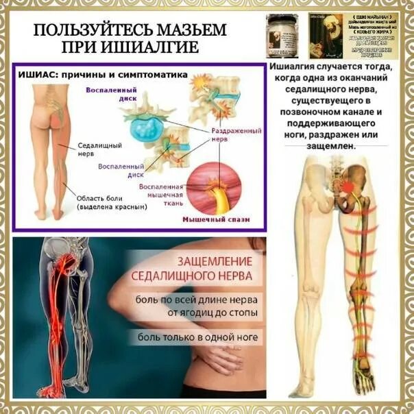 Где проходит седалищный нерв. Мазь при защемлении седалищного нерва. Защемление нерва мазь. Уколы при защемлении седалищного нерва.