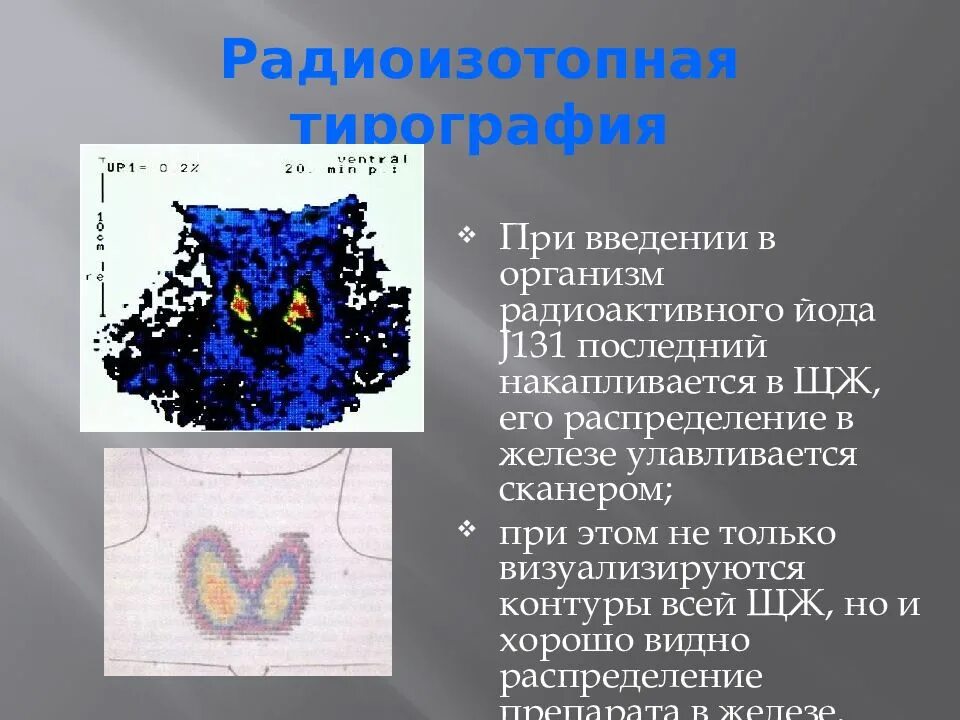 Радиоактивный изотоп йода. Сканирование щитовидной железы с радиоактивным йодом. Сцинтиграмма щитовидной железы. Сцинтиграфия щитовидной железы ДТЗ. Радионуклидная терапия щитовидной железы.