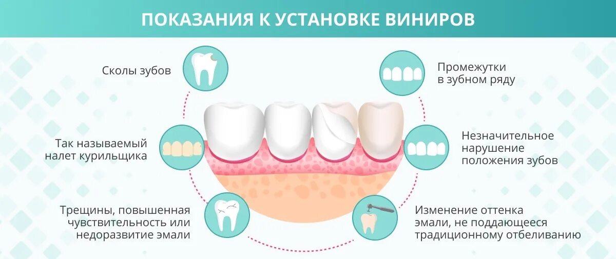 Противопоказания к изготовлению коронки. Схема установки виниров. Показания к винирам для зубов. Процедура установки виниров на зубы.