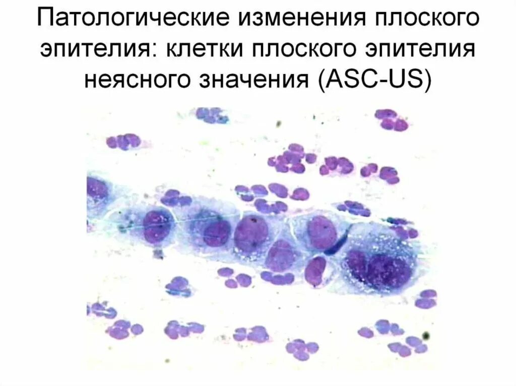 Атипия клеток плоского эпителия. Дискариоз клеток плоского эпителия шейки матки что это такое. Плоский эпителий микроскопия. Реактивные изменения клеток плоского эпителия.
