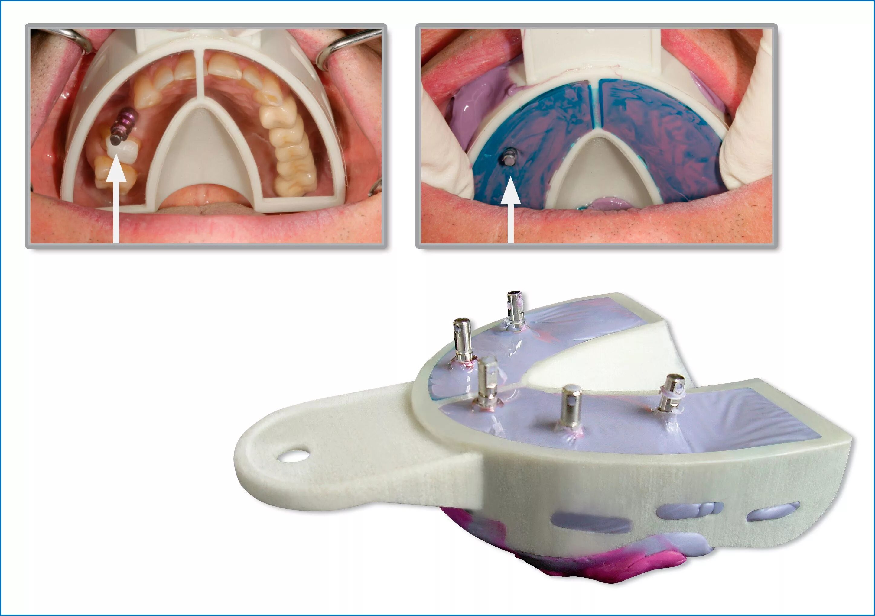 Имплантация sup aznona com. Многофункциональная педаль для Implant Center f27120. Индивидуальная ложка для имплантов. Слепочная ложка для имплантатов. Индивидуальные оттискные ложки.