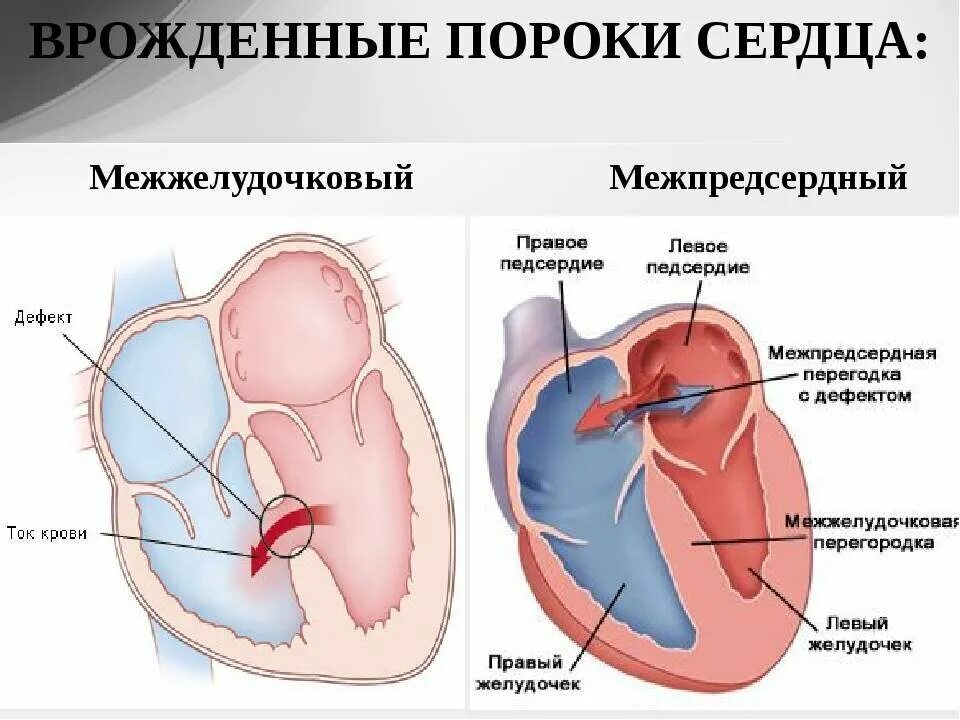 Недостаточность предсердия. Дефект межпредсердной перегородки схема. Формирование межпредсердной перегородки схема. Врожденный порог сердца.