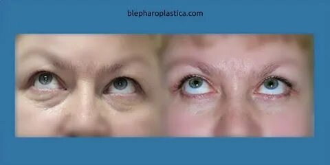 Грыжа на верхнем веке глаза