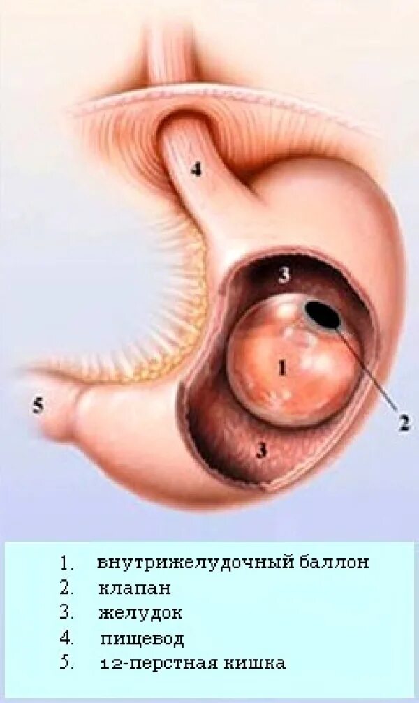 внутрижелудочный баллон медсил. внутрижелудочный баллон для похудения. бариатрическая операция баллон. внутрижелудочный баллон производители. операция внутрижелудочный баллон.