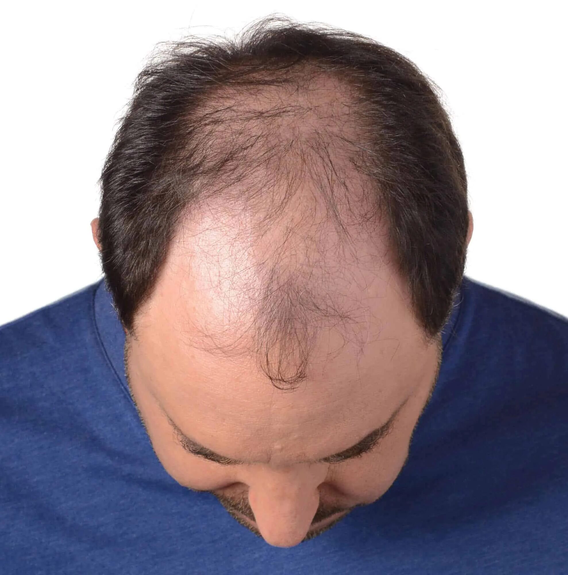 Быть в голове у мужчины. Голова мужчины сверху. Hair loss Top of the head. Hair loss man. Bald man hair loss.