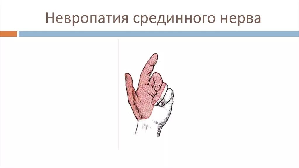 Клиника поражения срединного нерва неврология. Повреждение срединного нерва симптомы. Симптомы поражения срединного нерва нерва. Клинические проявления поражения срединного нерва.