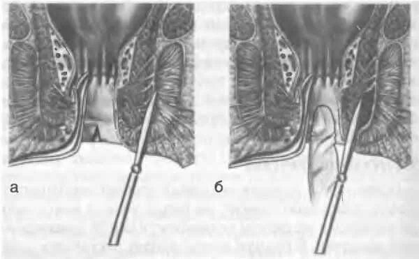 Боковая подкожная сфинктеротомия. Пельвиоректальный парапроктит. Подкожный парапроктит.