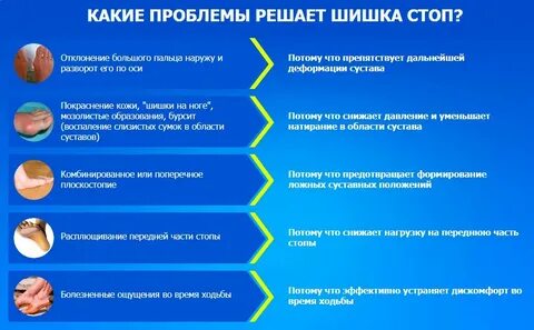 Лечение шишек стопы