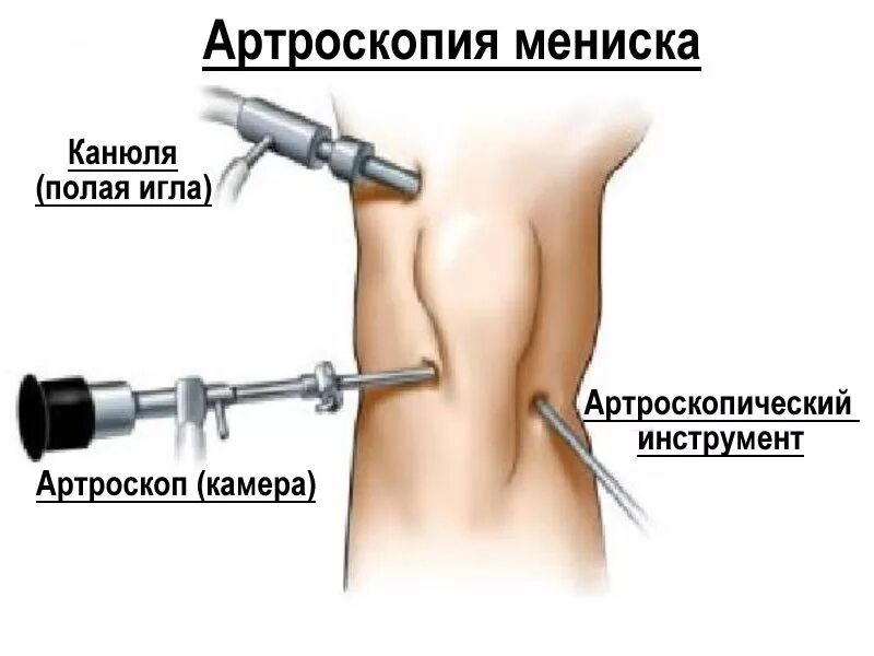 Операция на разрыв мениска артроскопия. Артроскопия коленного сустава разрыв мениска. Артроскопия мениска осложнения. Артроскопия ПКС коленного сустава.