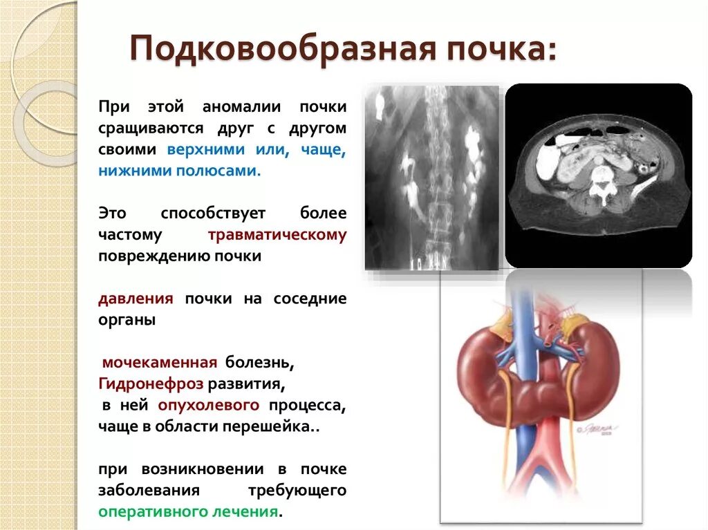 Сколько дают за почку. Аномалия развития почек подковообразная. Аномалии развития почек УЗИ. Патология развития почек подковообразная. Подковообразная почка клинические рекомендации.