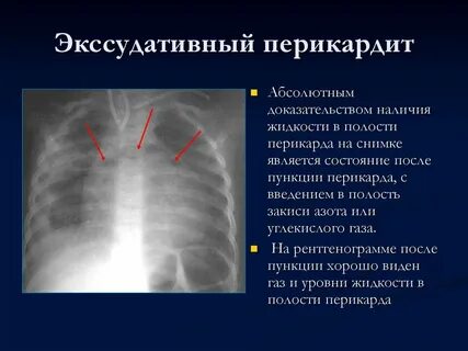 Панцирное сердце