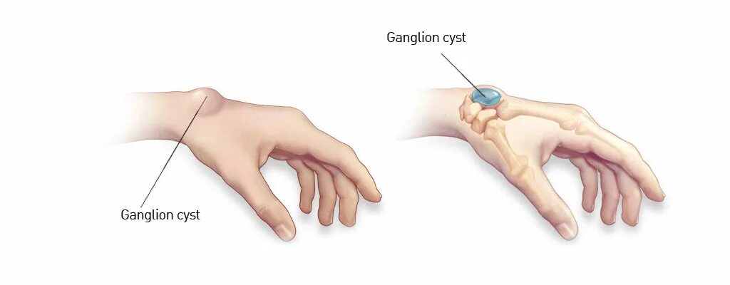 Гигрома лучезапястного СУСТАВF. Гигрома сухожильный ганглий. Гигрома (ганглий) лучезапястного сустава. Ганглион лучезапястного сустава.