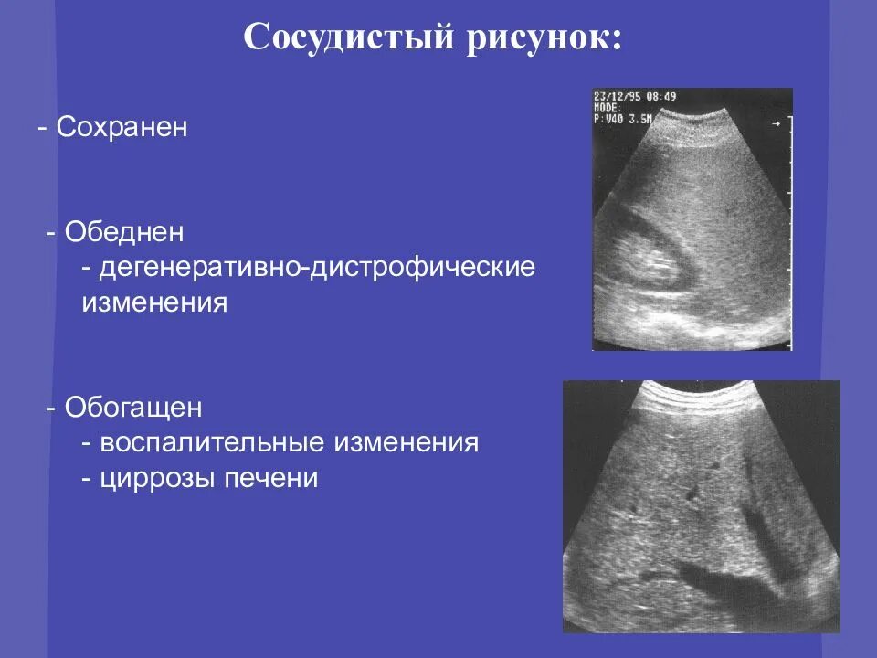 Изменения печени у ребенка. Усиление сосудистого рисунка печени на УЗИ. Усилен сосудистый рисунок печени. Обеднение сосудистого рисунка печени на УЗИ.